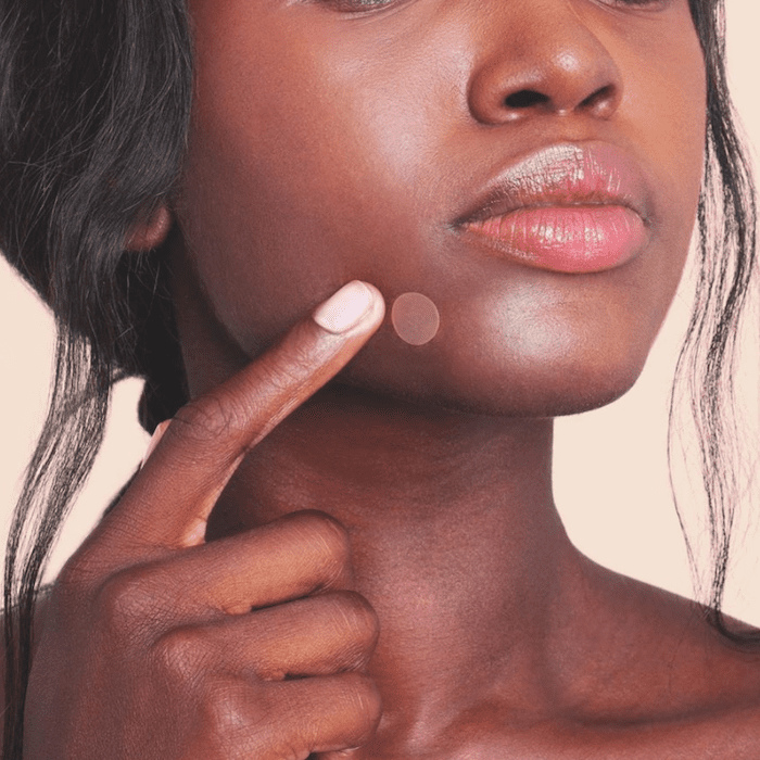 Is It Really That Bad to Pop a Pimple? Dermatologists Settle the Debate