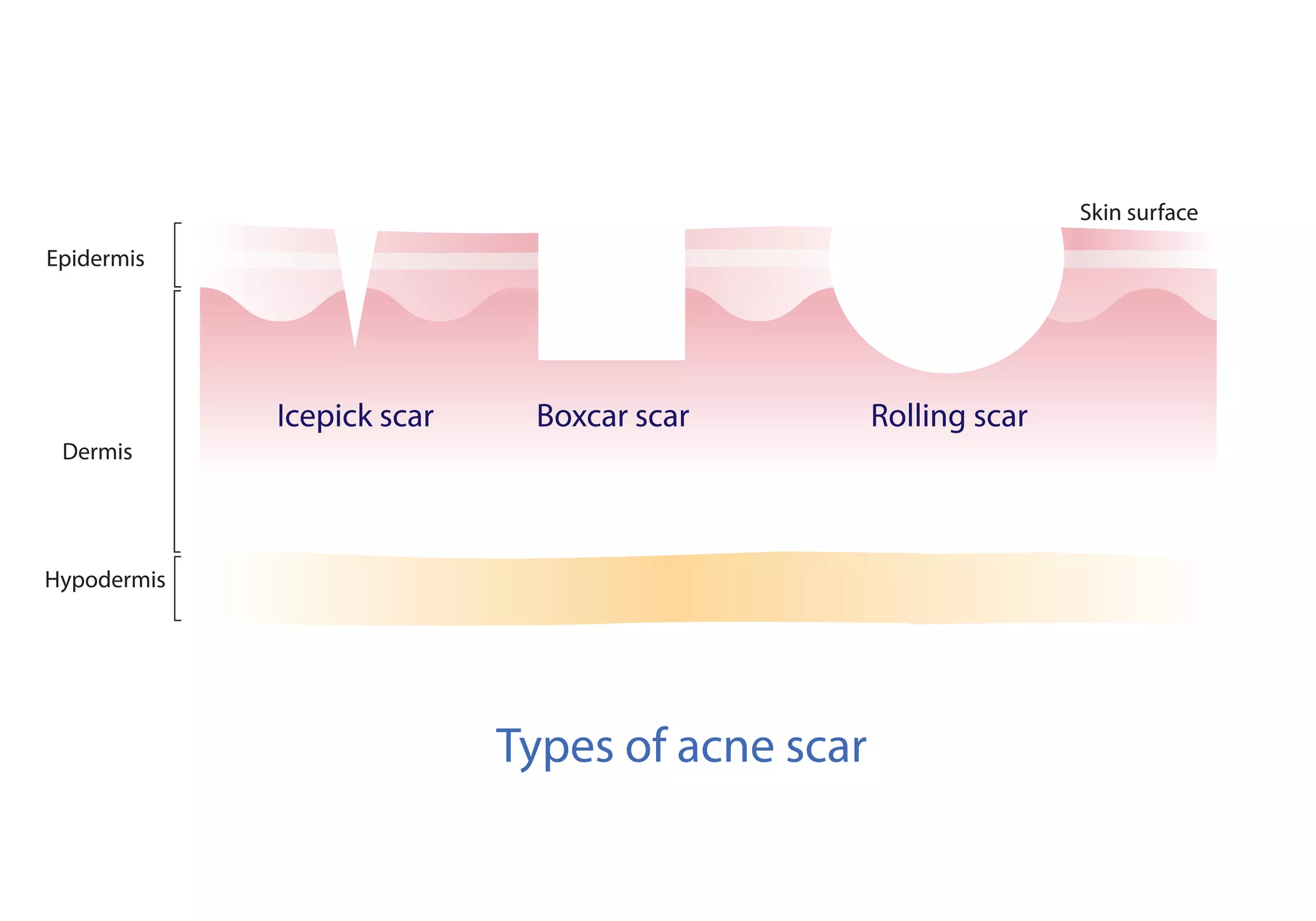 Visual representation of acne scars.