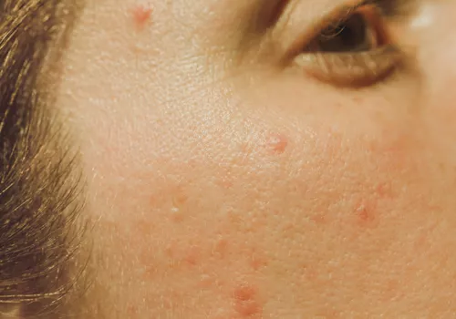 close up of acne