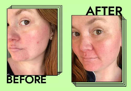 sunda riley acne oil before and after photo