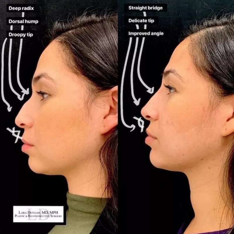 Liquid Rhinoplasty Results Before and After by Dr. Lara Devgan, MD, MPH