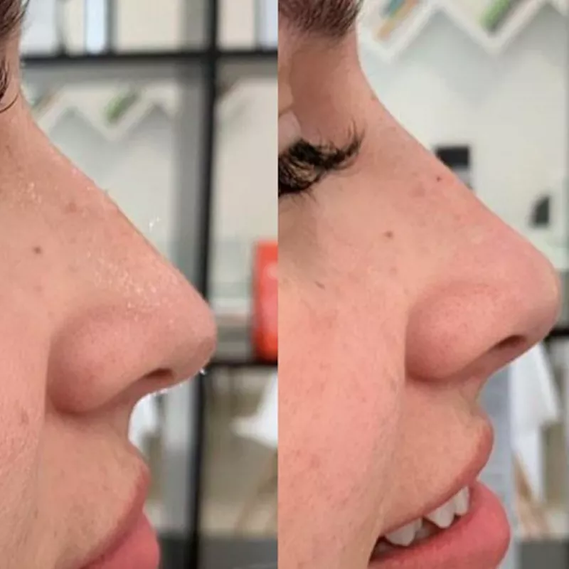 Liquid Rhinoplasty Results Before and After by Dr. Natalia Elizondo, MD