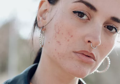 Woman with acne and redness