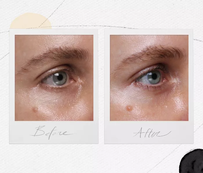 under eye fillers—before and after