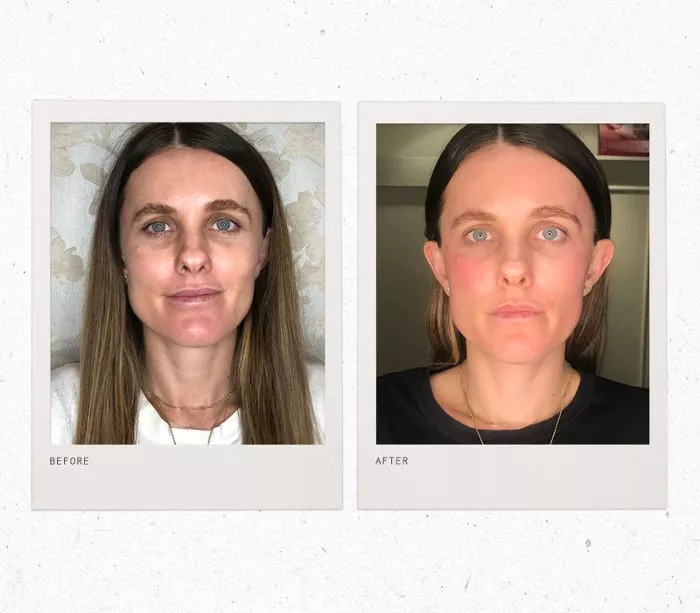 forma laser—before and after