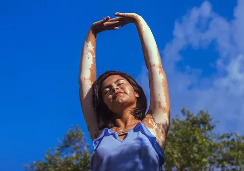 Woman with vitiligo standing in the sun