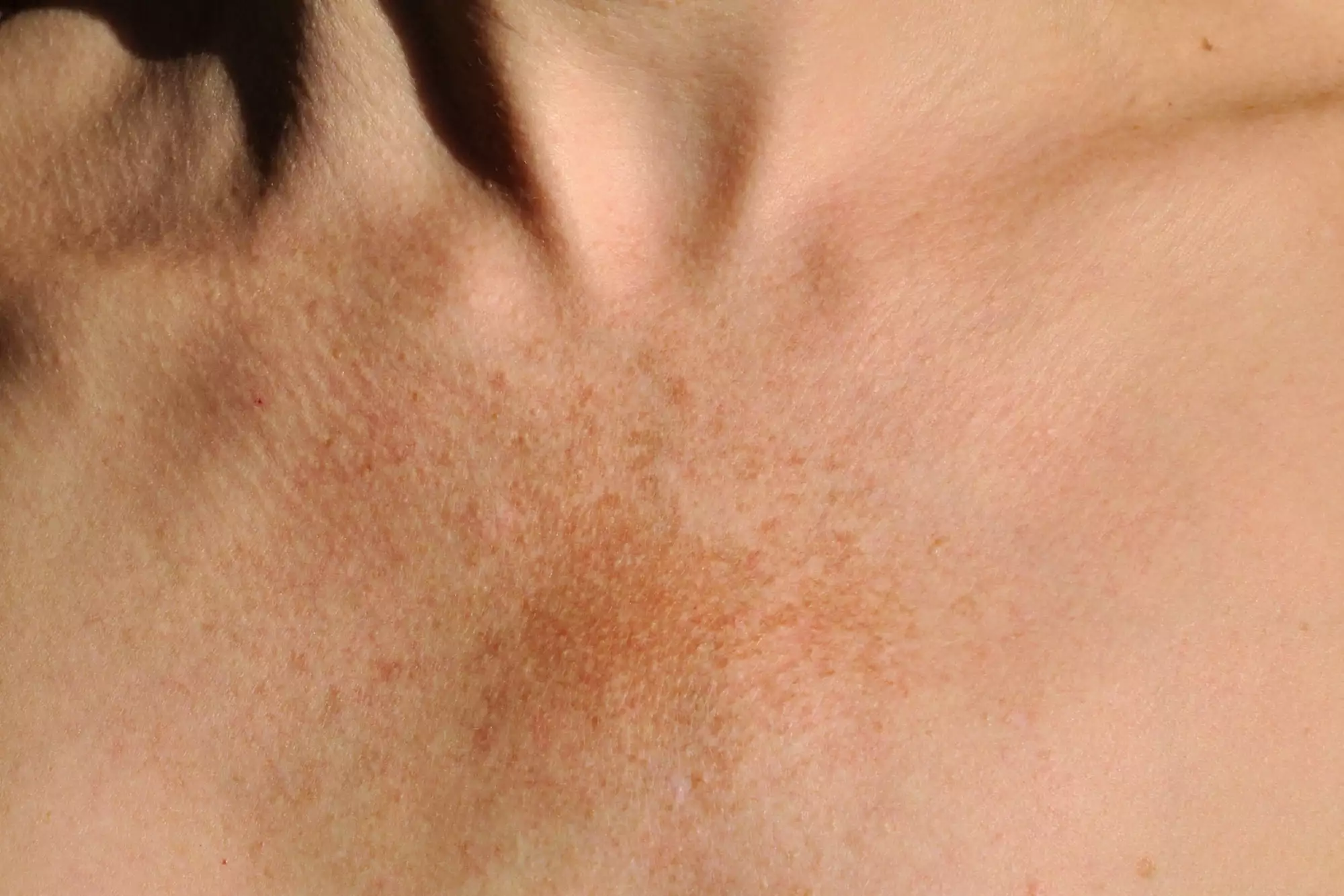 chest with melasma sunspots